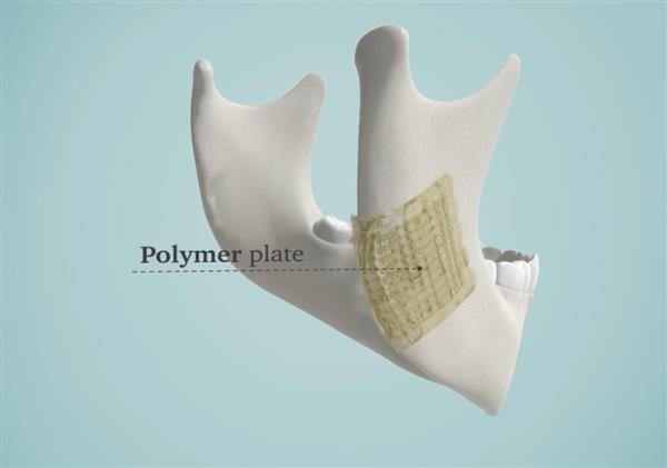 解決醫(yī)生煩惱 3D打印生物陶瓷修復骨骼


生物陶瓷,3D打印生物陶瓷,工業(yè)3d打印機,3D打印機價格,3D打印服務,3D打印技術,中國3d打印技術,上海3D打印,北京3D打印