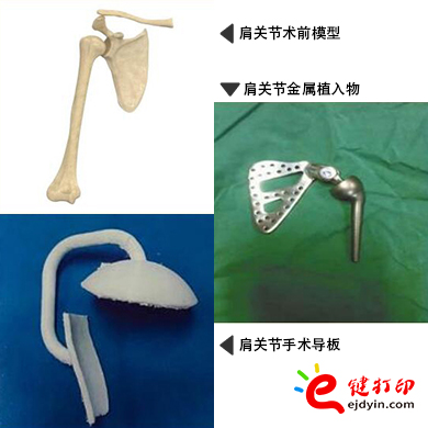 肩關節(jié)金屬植入物