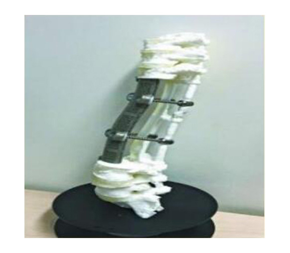 脊椎金屬植入物1